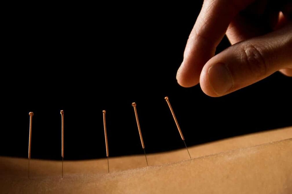 akupunktúra pre prostatitídu
