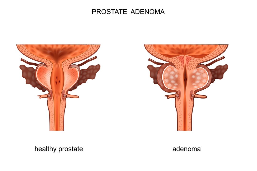 Zdravá prostata a adenóm