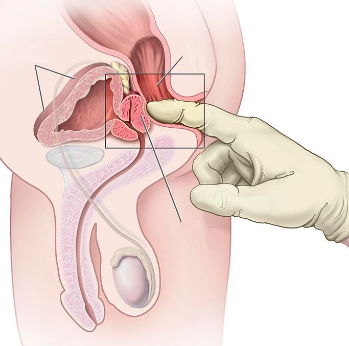 Masáž prostaty na liečbu prostatitídy