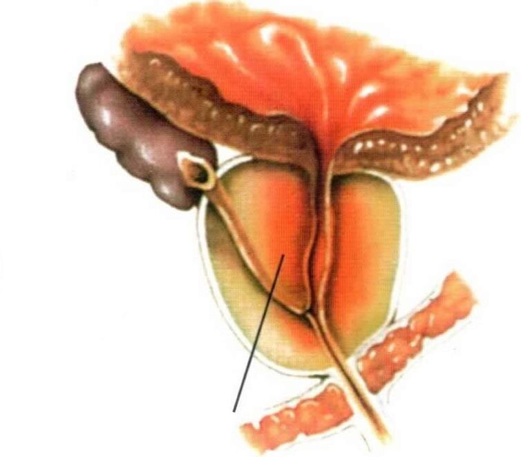 Zápal tkaniva prostaty pri chronickej prostatitíde